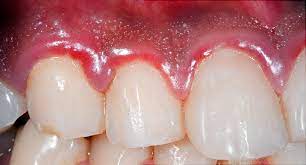 Healthy gums are firm and pale pink and fitted tightly around the teeth. How To Know If You Have Gum Disease And What To Do About It
