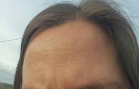 Granitos En La Frente Belleza Foro Bodas Net