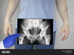 We how to read a pelvic xray detailed lecture radiology. X Ray Pelvic Bones Man Image Photo Free Trial Bigstock