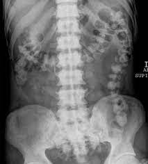 Imaging Findings Of Metabolic Bone Disease Radiographics