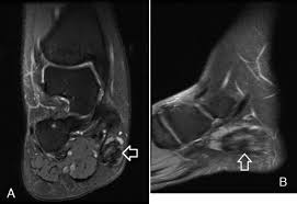 Mri and ultrasound have been utilised in the assessment of the plantar intrinsic foot muscles. Acute Exertional Medial Compartment Syndrome Of The Foot In A Teenager Sciencedirect
