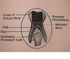 Pulpotomy Root Canal Of Primary Baby Teeth Kids Smiles Pediatric Dentistry