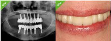 Low cost dental implants for seniors have many benefits. Cost Of Full Mouth Dental Implants In Dubai Jlt Dentist In Dubai
