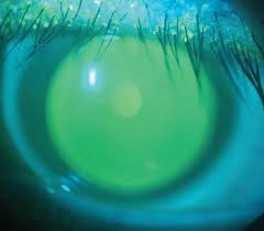 Image result for Eye Rest Green 1983 Hussmann