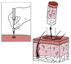 This is the most commonly preferred method of biopsies. Skin Biopsy Fv Hospital