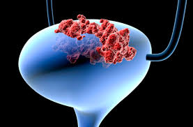 The treatment for bladder cancer depends on your individual type of bladder cancer. Bladder Cancer Your Personal Risk And How To Reduce It Health Essentials From Cleveland Clinic