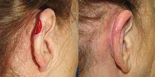 Some lesions are small, fairly simple to excise and may leave only slight scars. Ear Reconstruction Gallery Skin Cancer And Reconstructive Surgery Center