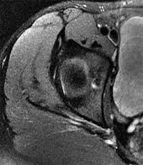 Image result for Hip Labral Tear