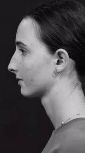 Before and After rhinoplasty.