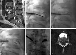 Bone Cement Deposition Patterns with Plasma-Mediated Radio-Frequency  Ablation and Cement Augmentation for Advanced Metastatic Spine Lesions