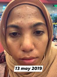 Jerawat biasa disebabkan oleh bakteri, sedangkan penyebab fungal acne adalah jamur malassezia. Produk Jerawat Biasa Takkan Berkesan Wanita Ini Dedah Cara Yang Betul Bagi Rawat Fungal Acne Hijabista