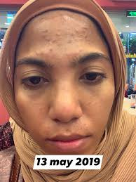 Cara menghilangkan jerawat yang kedua adalah dengan menggunakan obat jerawat. Produk Jerawat Biasa Takkan Berkesan Wanita Ini Dedah Cara Yang Betul Bagi Rawat Fungal Acne Hijabista