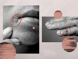 Image result for genital herpes