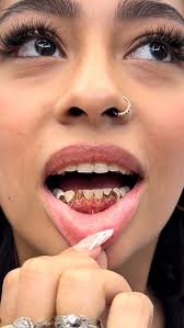 For all the millions of fans waiting, Lorelei finally got her braces on.  See her video to the left to follow her journey. #braces #smile #kids  #bully #sweet #love #fun #transformation #dentist #