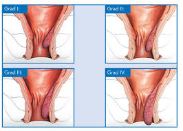 Viele menschen gehen wegen eines verdachts auf hämorrhoiden zum arzt, in diesem fall zu einem gastroenterologen. Hamorrhoiden Proktologie Und Chirurgie Proktologe Chirurg In Munchen