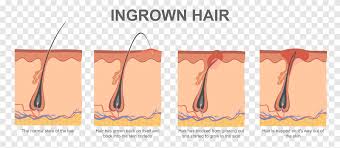 This will not only help you prepare your skin before epilating, but it will also make the whole hair removal. Ingrown Hair Hair Removal Electrolysis Waxing Hairs People Hair Png Pngegg