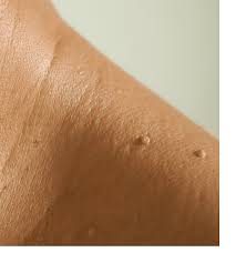 Image result for Skin Tag