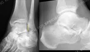 Image result for Calcaneus Compression Fracture