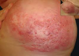 What are the symptoms of inflammatory breast cancer? Dermoscopy Of Inflammatory Breast Cancer Abstract Europe Pmc