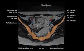 The main focus of this article will be the pelvic floor muscles. Casestacks Com Pelvic Anatomy On Mri