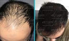 قبل وبعد زراعة الشعر clinic