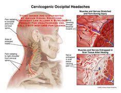 Pin On Headaches