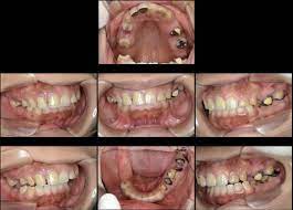 治療画像付き】この虫歯はひどい状態？今後の治療の流れがわかる！