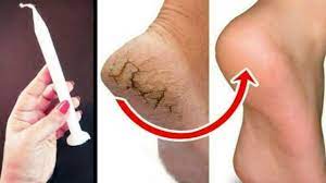 Water on your feet can take away natural oils from the skin and can leave the skin rough, dry or both. In Just 5 Minutes Get Rid Of Cracked Heels Permanently Magical Cracked Heels Home Remedy Youtube