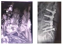 Image result for Spinal Infection