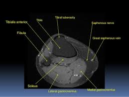 Injuries of the patellofemoral joint. Mri Knee Joint Anatomy