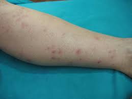 Image result for Microscopic Polyangiitis