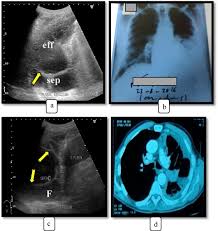 A subpulmonic effusion may follow the contour of the diaphragm making it. In Diagnosis Of Pleural Effusion And Pneumothorax In The Intensive Care Unit Patients Can Chest Us Replace Bedside Plain Radiography Sciencedirect