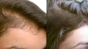 That's why you should always dose it carefully, the way you would with skin serum products. Hair Fall Is One Of The Most Common Problem Up To 100 Hair Loss Is A Normal Thing But If You Are Losing More It Severe Hair Fall Hair Laser