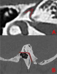 Sex estimation with parameters of the facial canal by computed tomography  using machine learning algorithms and artificial neural networks | BMC  Medical Imaging | Full Text