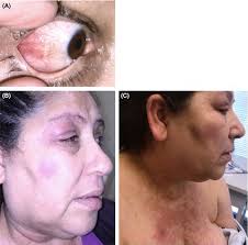 Periorbital swelling and episcleritis may be a sign of cutaneous lupus  erythematosus
