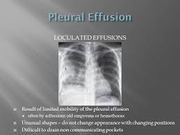 It can also be life threatening. Loculated Pleural Effusion Pleural Effusion Pleural Fluid Ldh Two Thirds Of Upper Limit For Serum Ldh Stewart Hauptman