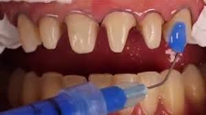 The universal adhesive prime&bond active was used on. Adhesive Cementation Of Ceramic Veneers Youtube