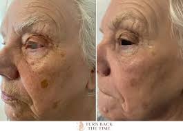 The most beautiful scar you will ever have…. A Tan