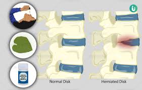 Check spelling or type a new query. Slipped Herniated Disc Symptoms Causes Treatment Medicine Prevention Diagnosis