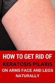 This ingredient also helps dissolve the buildup that causes kp's telltale bumps and redness. How To Get Rid Of Keratosis Pilaris On Arms Face And Legs Naturally Skin Bumps Keratosis Pilaris How To Get Rid Of Keratosis