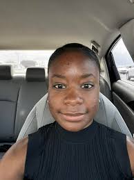 How to clear up acne scars and dark marks