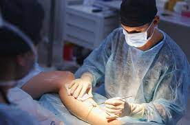 Suction Thrombectomy Procedure Pretoria