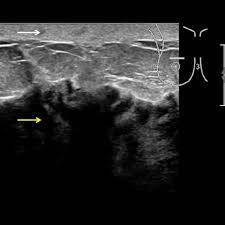 Ibc skin thickening and diffuse tumor areas are more easily visualized by mri. Inflammatory Breast Cancer Eurorad