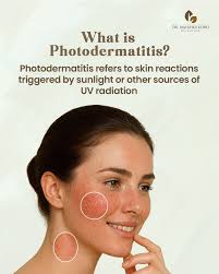 Image result for Photodermatitis