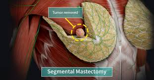 Image result for Mastectomy