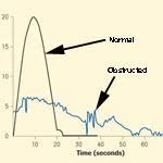 Prostate Symptoms Bladder Outlet Obstruction The British