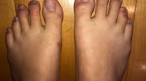 Cdc reveals at least 21 americans have suffered life threatening allergic reactions to pfizer's covid vaccine. Dermatologist Explains If Covid Toes Skin Rashes Are Symptoms Tied To Virus Infection Wkrc