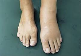 Symptoms the symptoms of charcot foot may include: Wenn Der Fuss Schmerzlos Zerstort Wird