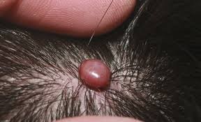 Risk factors and role of genetics. Hemangioma Hemangioma Of Skin Spine Liver Causes Treatment