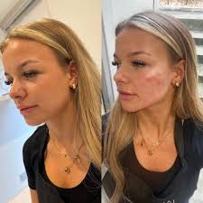 🤍 COMPETITION TIME 🤍 With my new treatments now available I want to give  one of you the chance to win 1ml of dermal filler which can be used